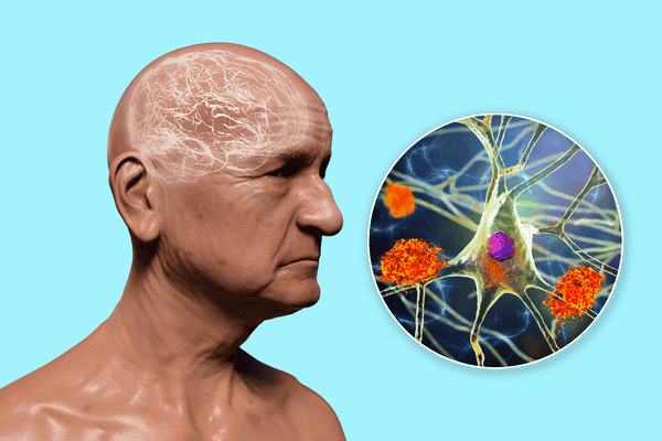 Recognizing the Early Signs of Alzheimer’s: A Comprehensive Guide