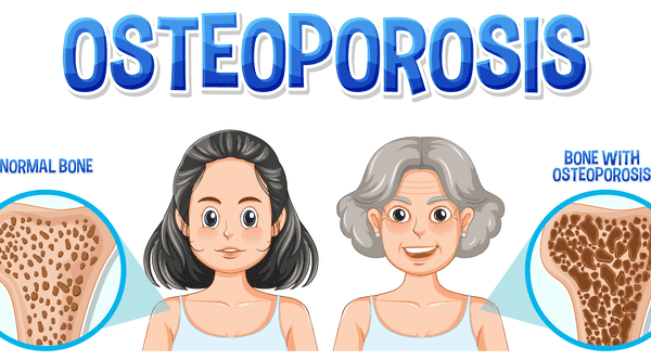 The Story of Eleanor: Battling Osteoporosis in…